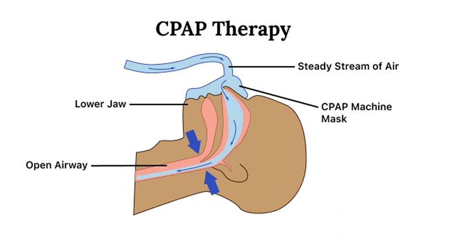 CPAP therapy